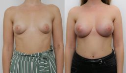 Breast Augmentation 330cc Enhanced voluptuous