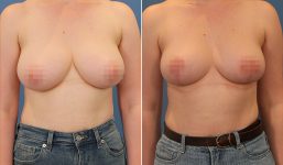 Breast Reduction Patient 10