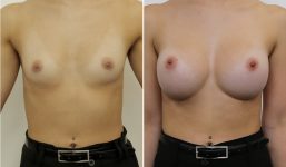 Breast Augmentation 375cc Full Enhanced voluptuous